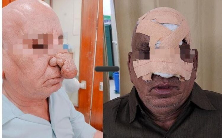  रेलवे ने पौटैटो ट्यूमर के सफल ऑपरेशन से लौटाई पेंशनर की खुशियां